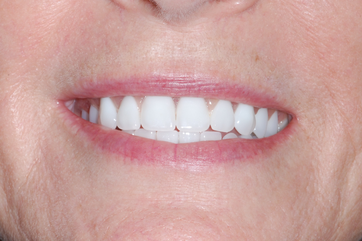 All-On-Four with Plastic Denture Teeth