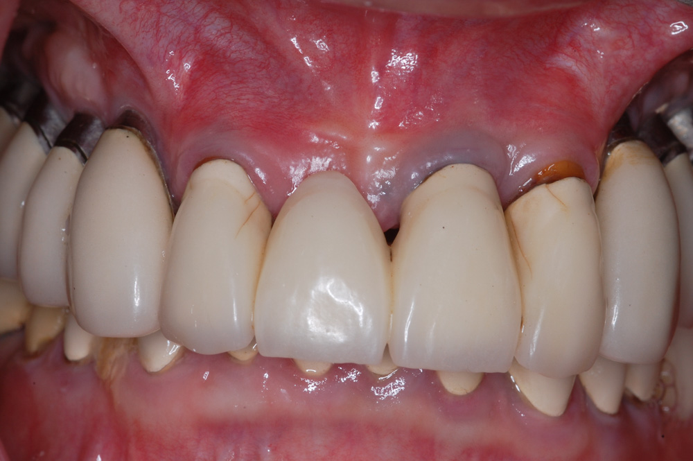 replacement-of-several-teeth-02.jpg