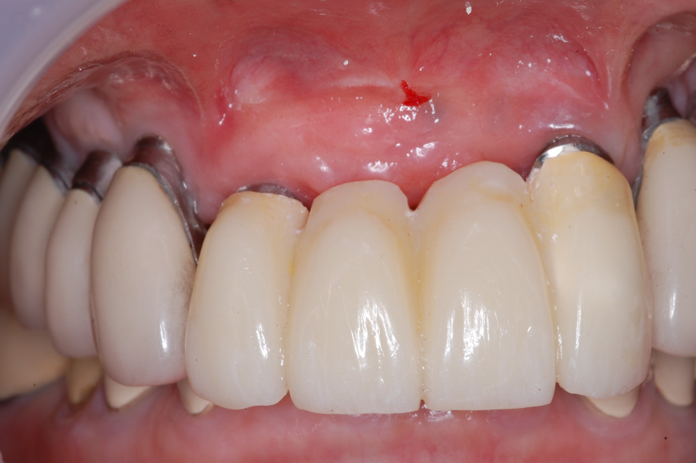 replacement-of-several-teeth-03.jpg