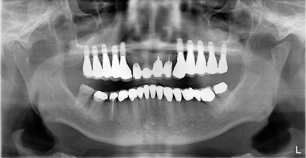 replacement-of-several-teeth-05.jpg