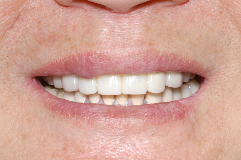 replacement-of-several-teeth-04.jpg