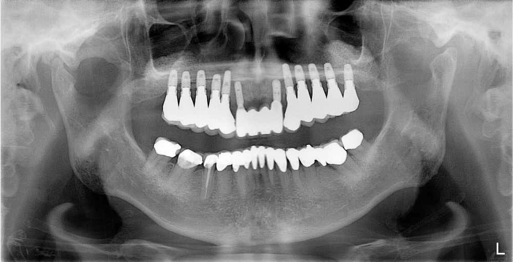 replacement-of-several-teeth-06.jpg