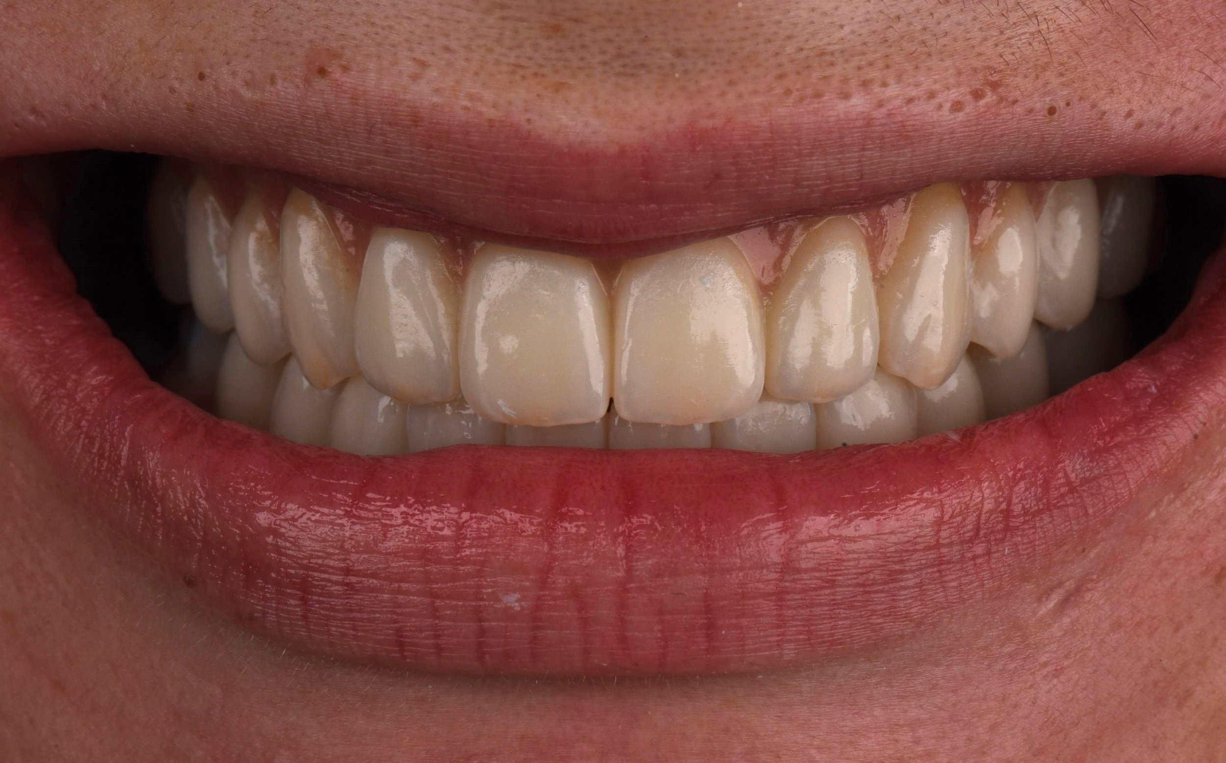Full Mouth Reconstruction/Implants