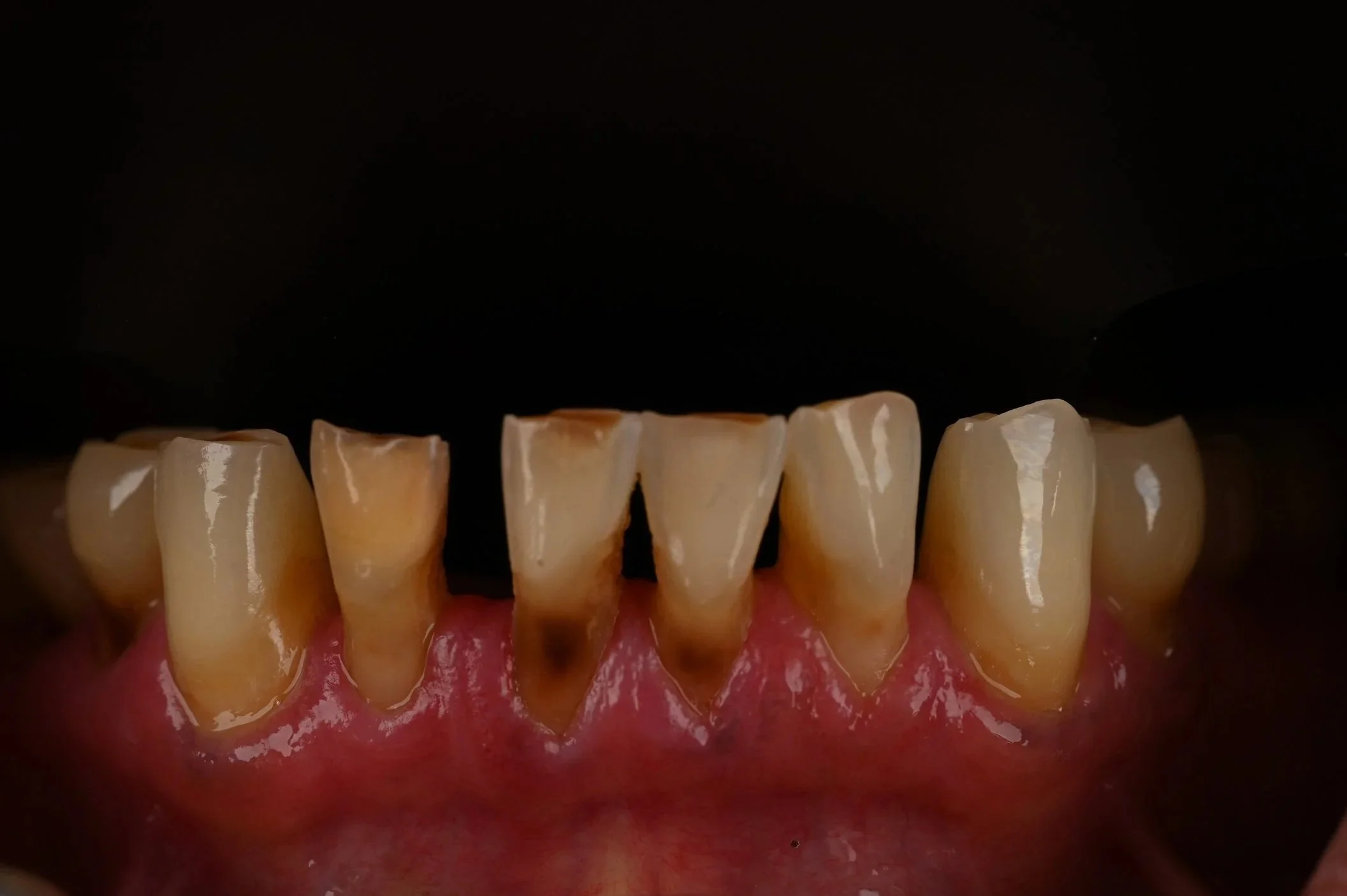 Dental Veneers (Before)