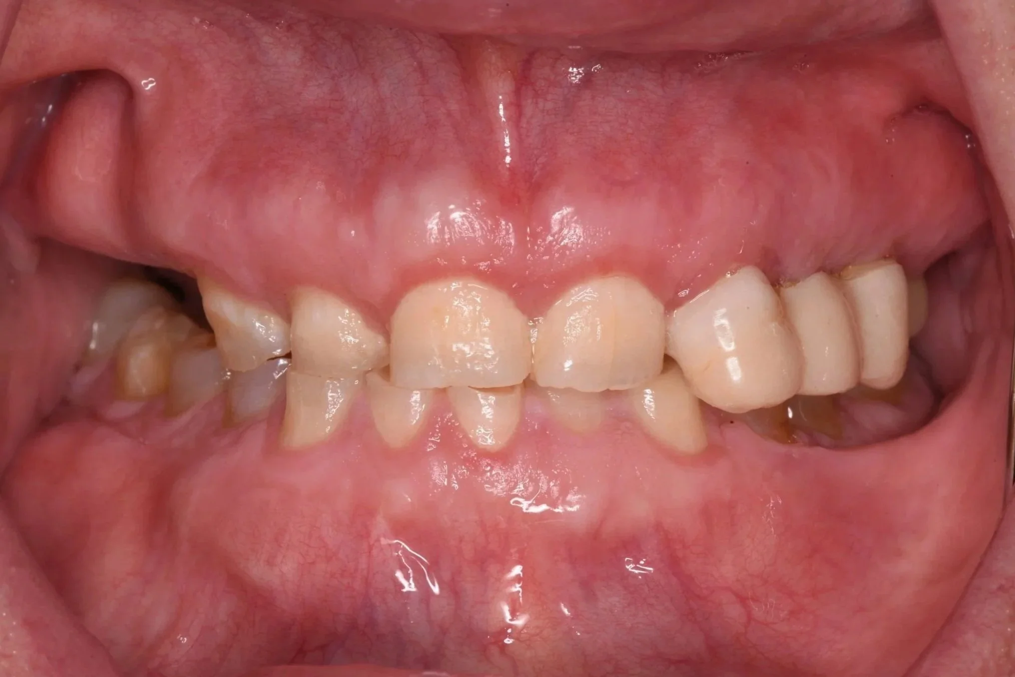 Full Mouth Reconstruction/Implants and teeth (Before)
