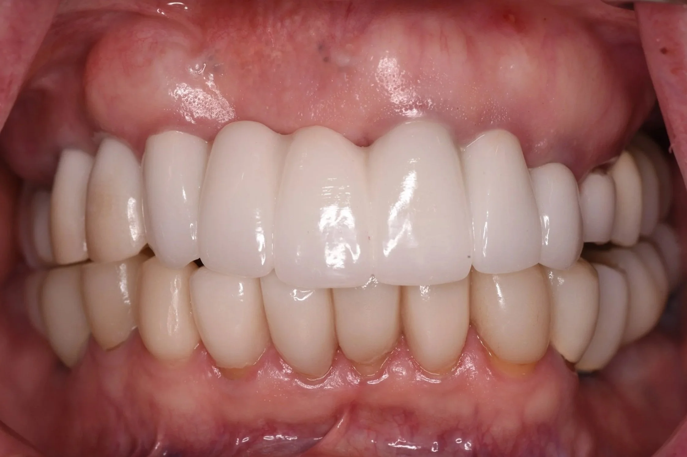  Full Mouth Reconstruction ALL on X (Before)