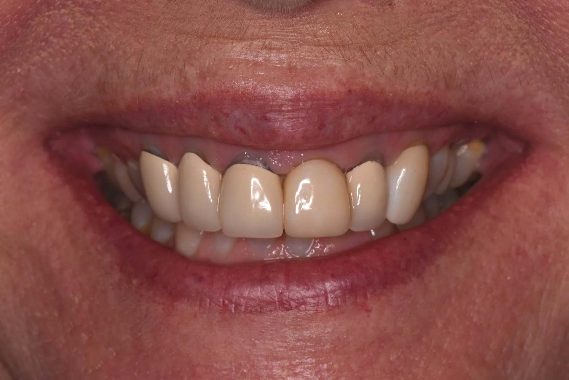 Dental Crowns (Before)