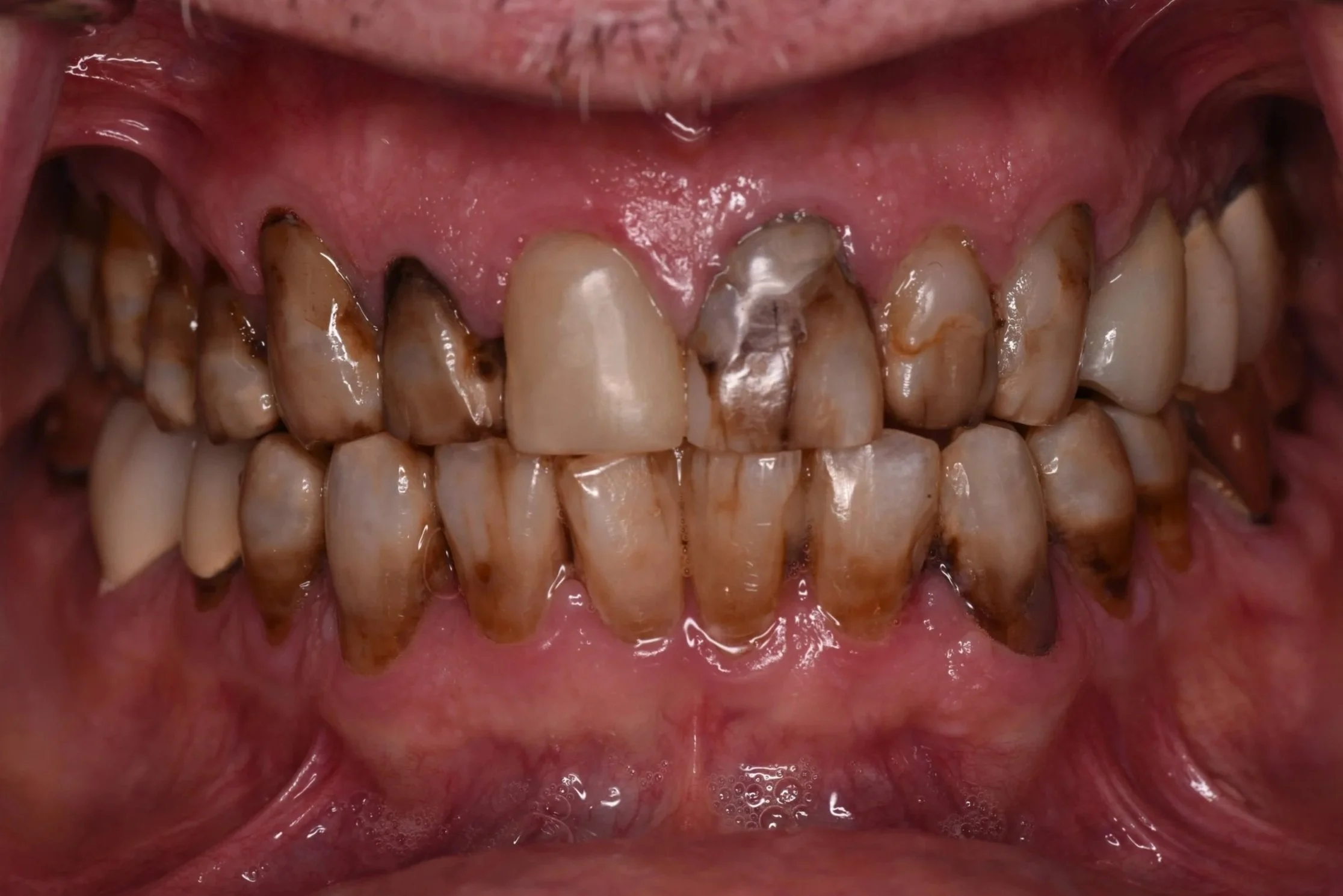 Full Mouth Reconstruction/no implants (Before)