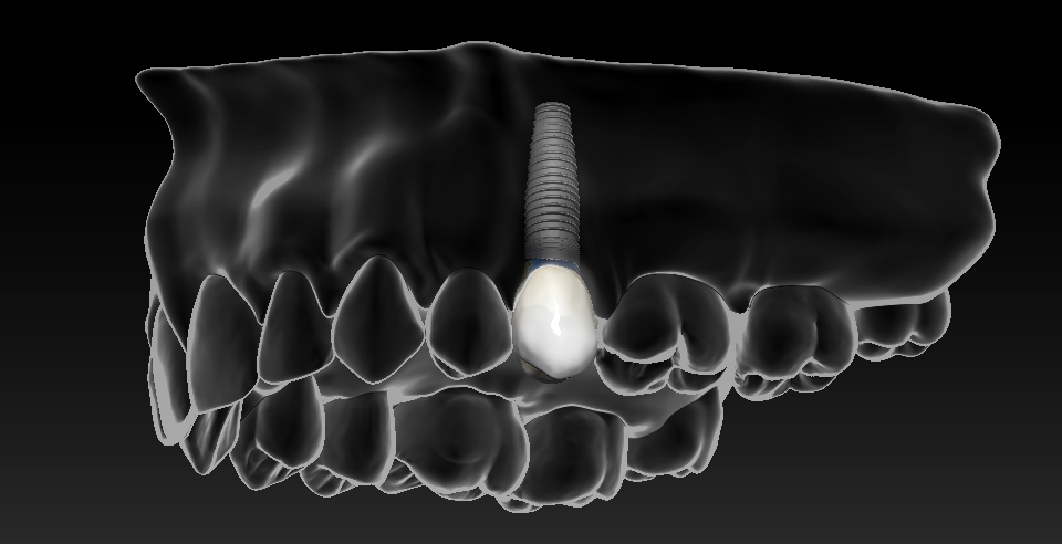 Implants .png