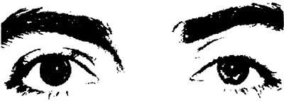 Fig. 5. Pharmacologic sympathetic stimulation, right-sided. Palpebral fissure wide open, protrusion, mydriasis. From Hollwich(16), with kind permission.