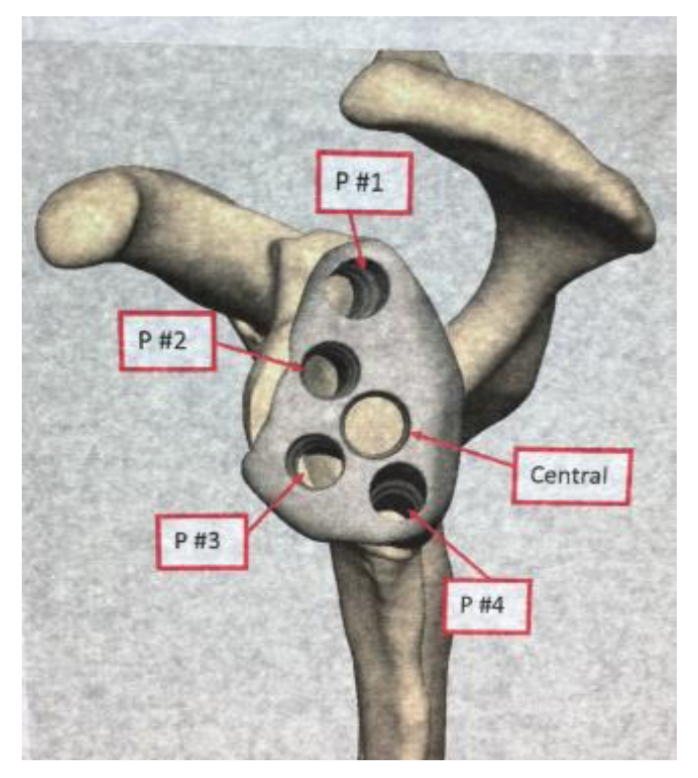 REVERSE TOTAL SHOULDER REPLACEMENT4.png