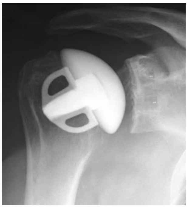 Anatomic Total Shoulder Replacement2.png