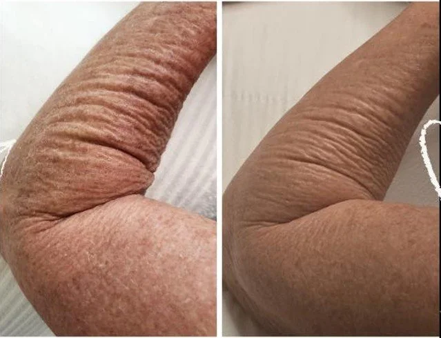 Warm Plasma before and after arm