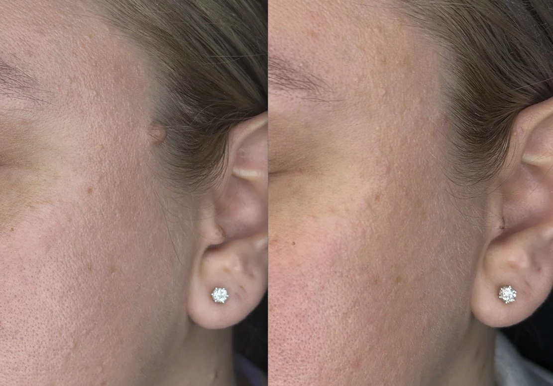 Skin-Transformations-Lesion-Removal-before-after03.jpg