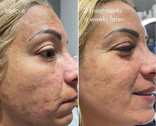 Warm Plasma on face scarring before and after