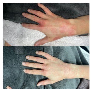 Skin-Transformations-Cold-Fusion-Plasma-before-and-after03.jpg