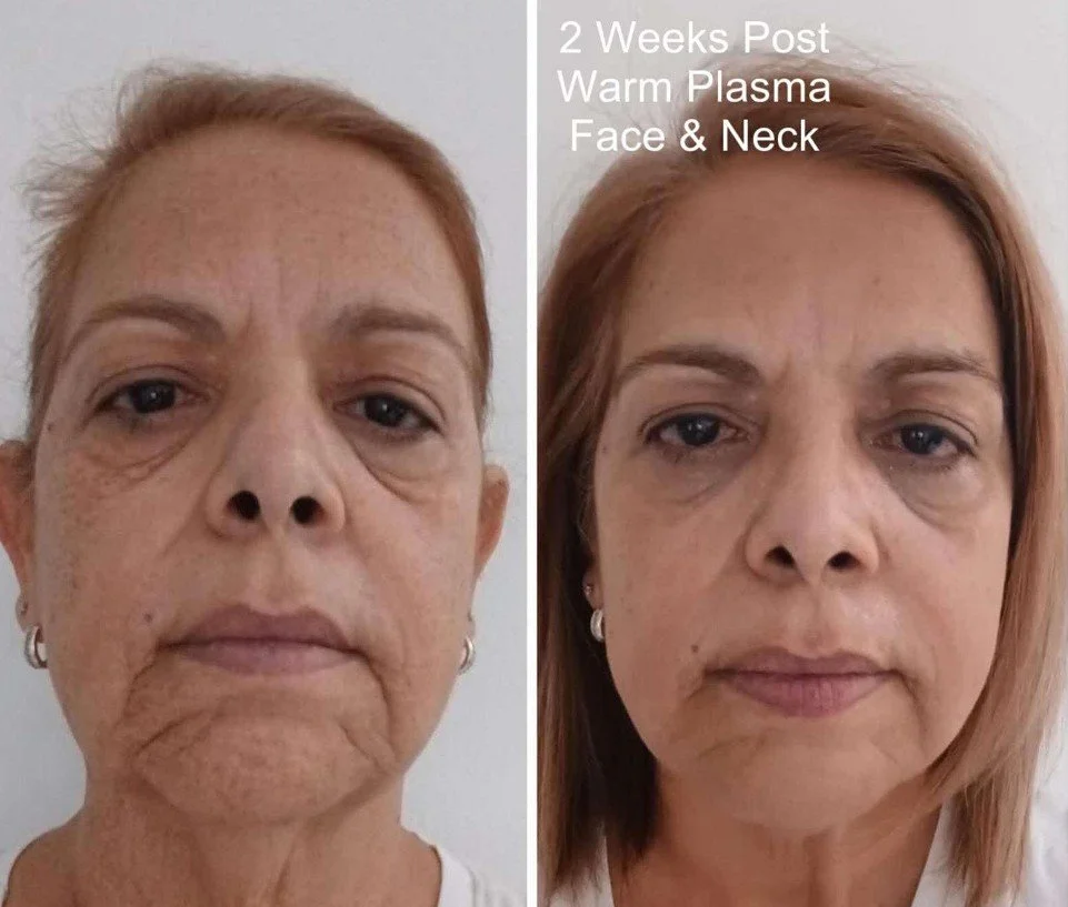 Warm Plasma before and after