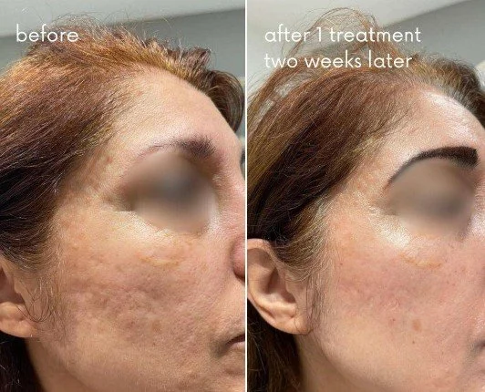 Warm Plasma on scarring before and after 2