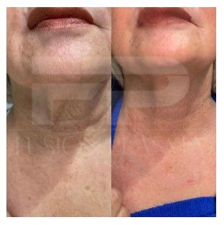 Warm Plasma before and after neck