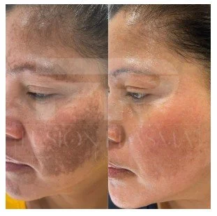 Warm Plasma before and after pigmentation