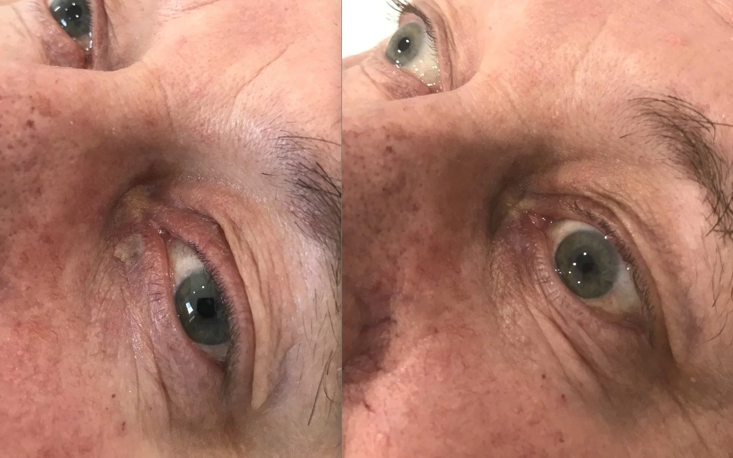 Skin-Transformations-Lesion-Removal-before-after04.jpg