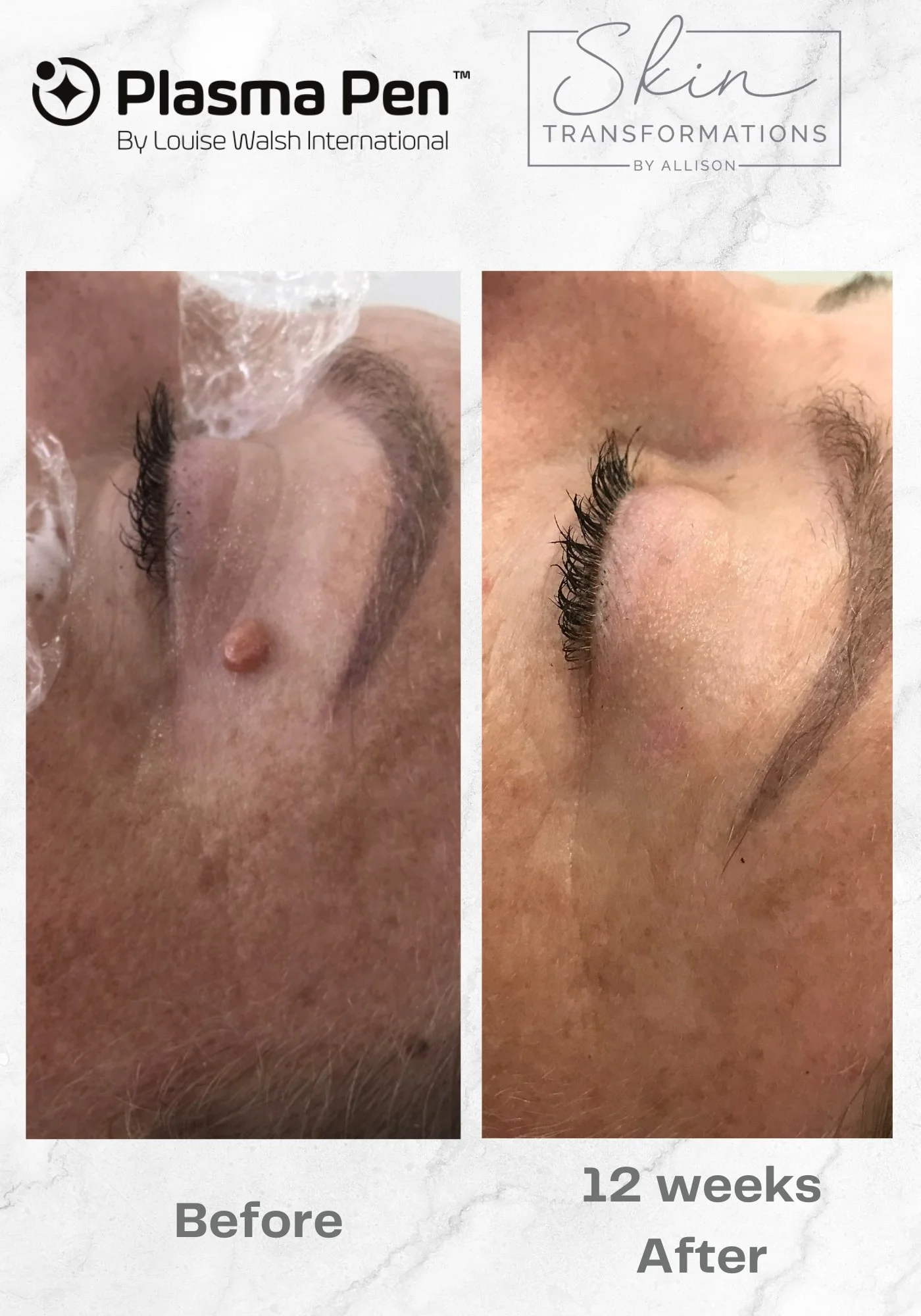 Skin-Transformations-Lesion-Removal-before-after-12 weeks.jpg