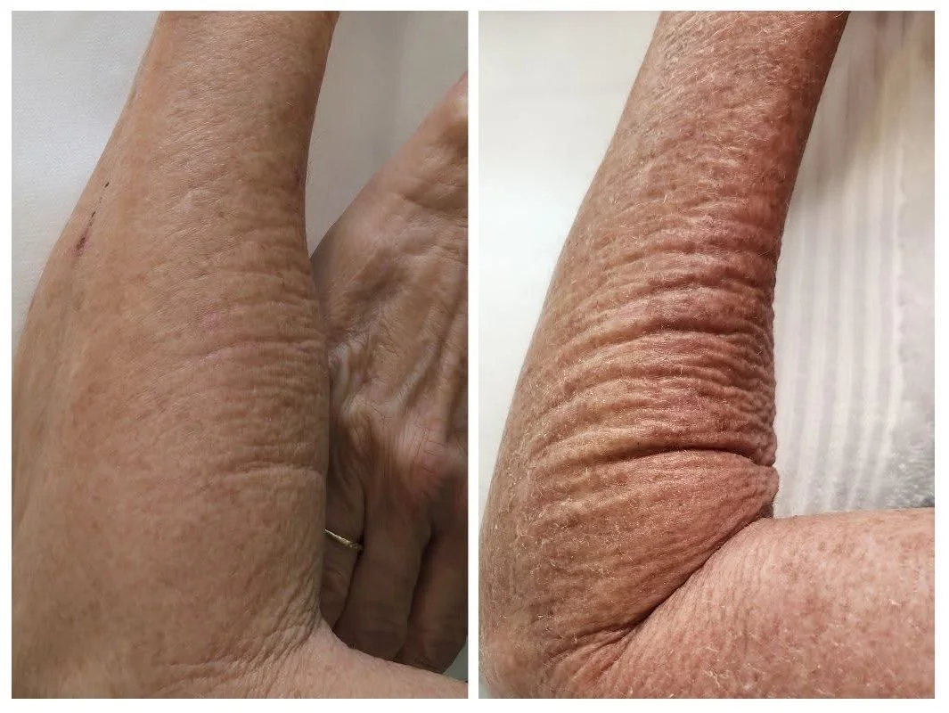 Warm Plasma before and after arm