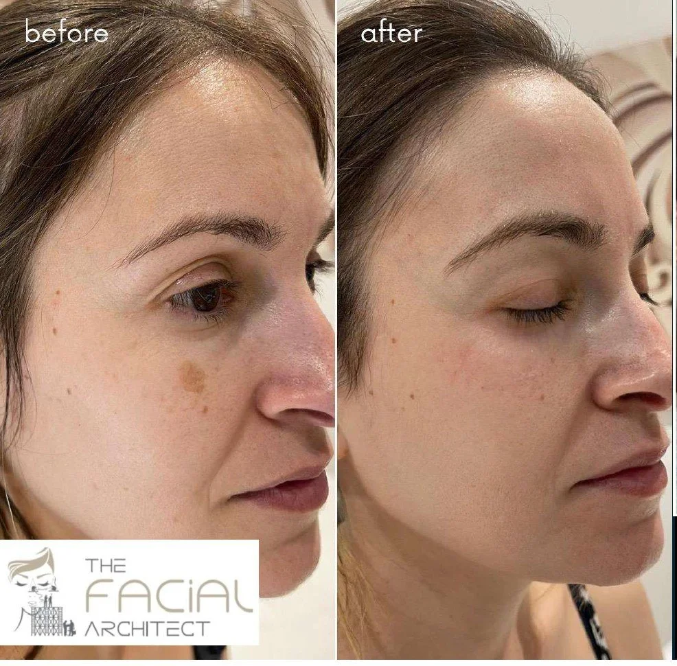 Warm Plasma before and after