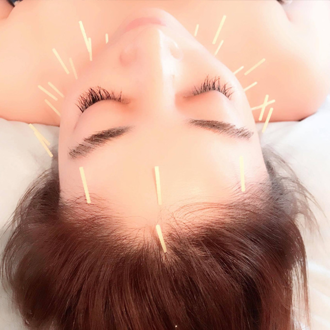 201906_lightupweekend_work_acupuncture.jpg