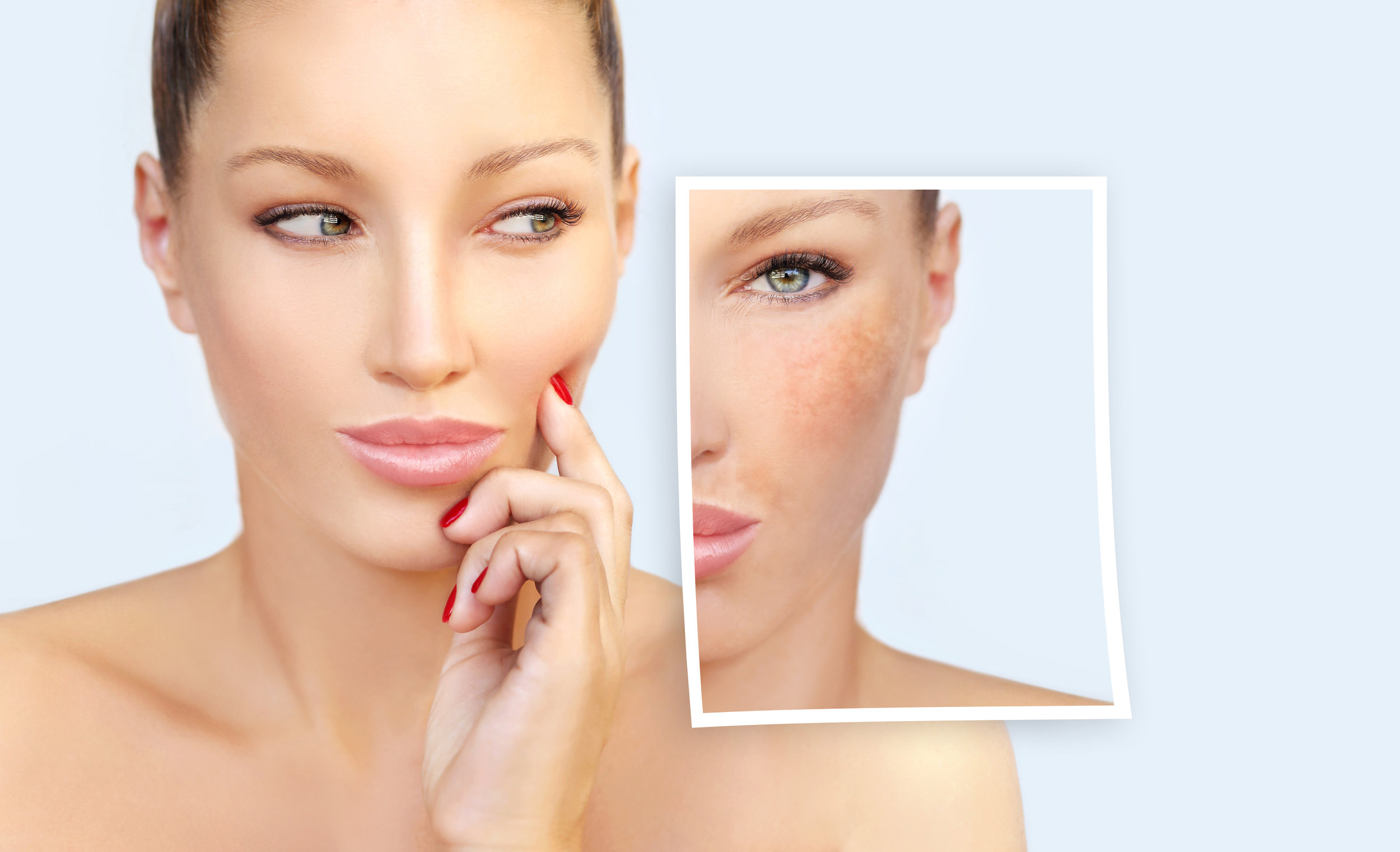 Q&amp;A About Hyper-pigmentation