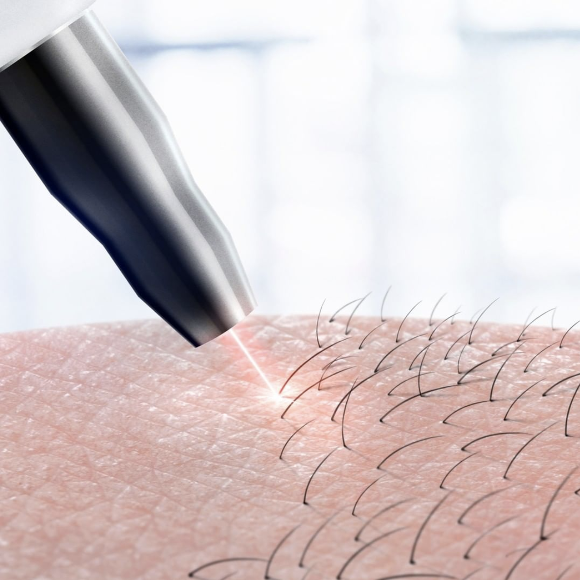 What is the best laser for excessive facial hair growth?