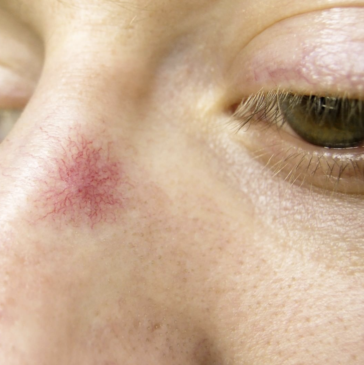 "Does regular tretinoin use make spider veins on the face worse?"