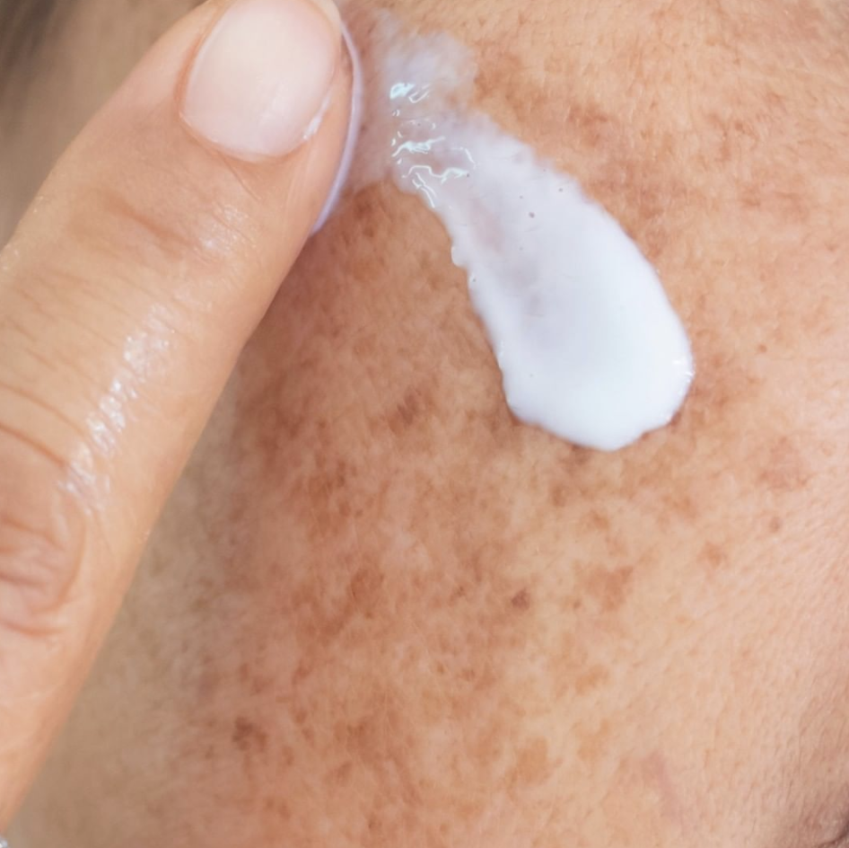 "How do I treat Melasma?"