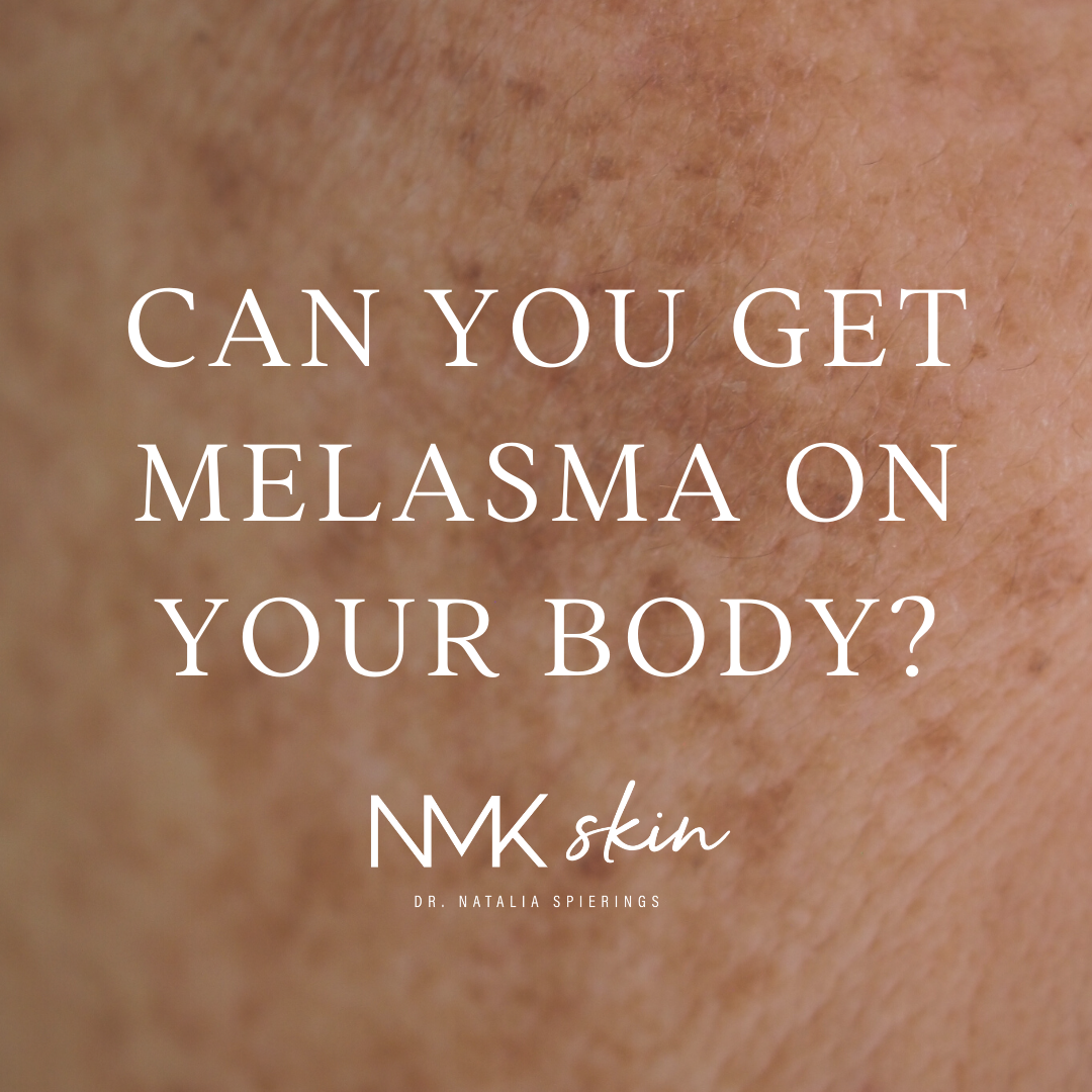Can you get melasma on your body?