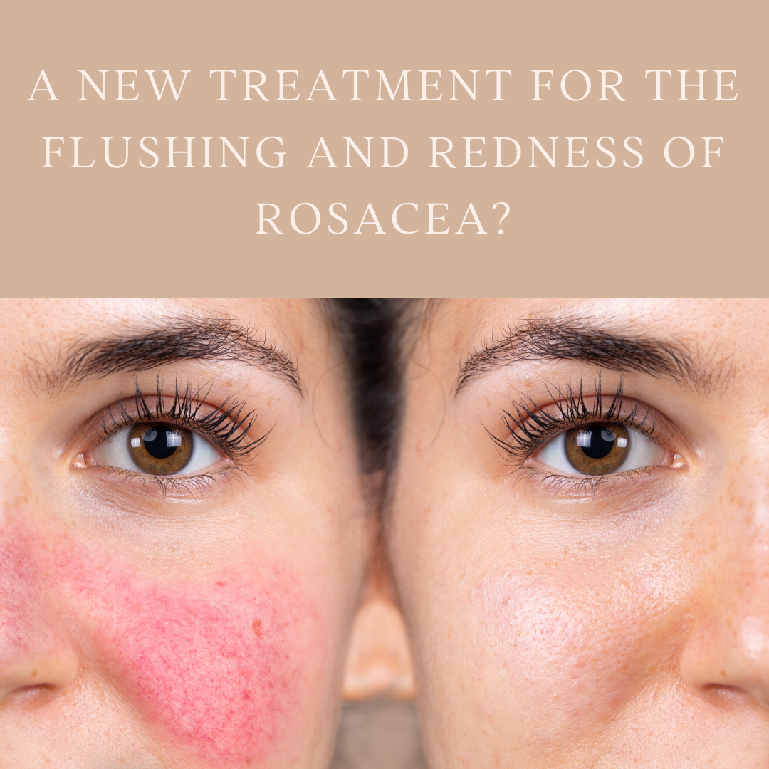 A new treatment for the flushing and redness of rosacea?