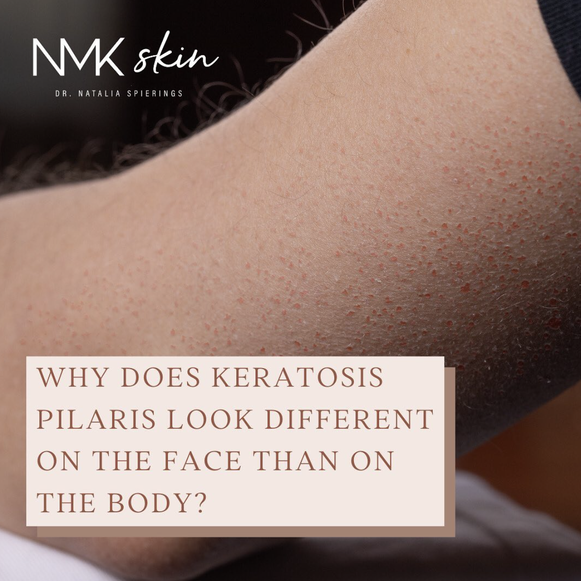 Why Does Keratosis Pilaris Look Different on the Face Than on the Body?