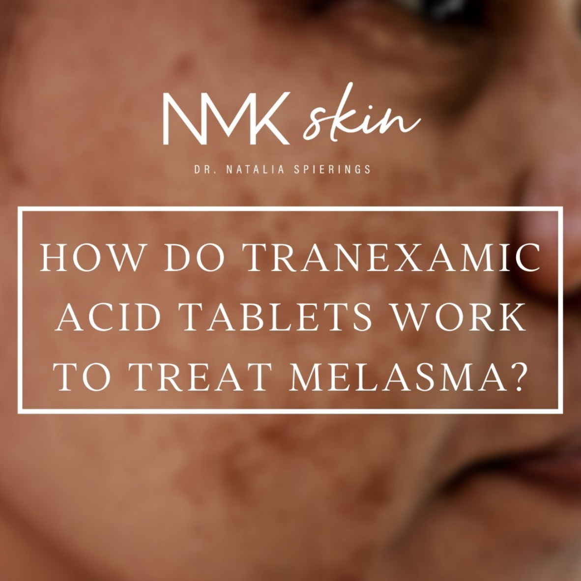 How Do Tranexamic Acid Tablets Work to Treat Melasma?