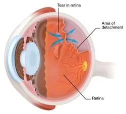 retinal tear.jpg
