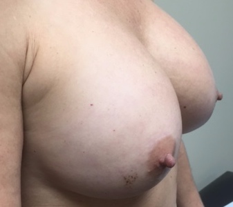 Breast Asymmetry Correction