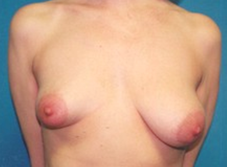 Breast asymmetry