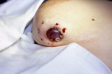 Patient A - Breast Extrusion Complication