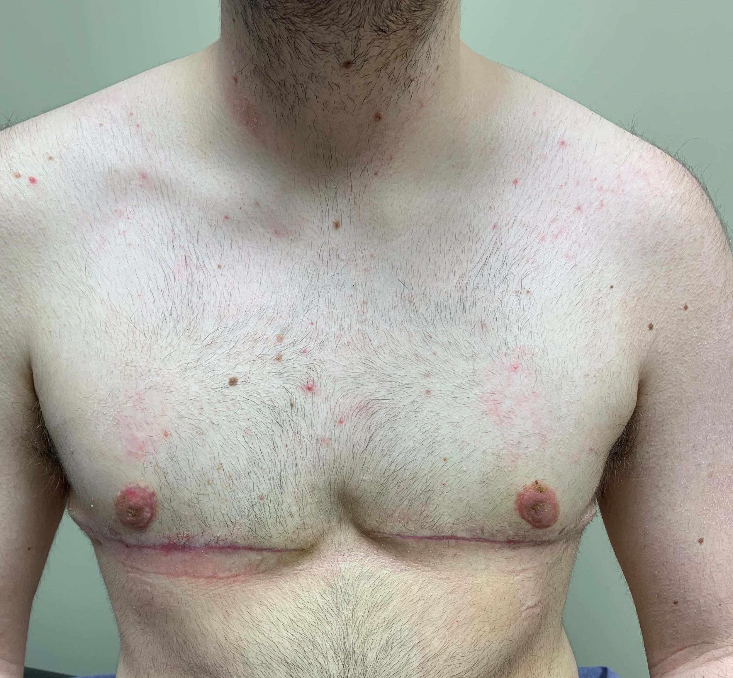   6 weeks Post-Operative Grade II Gynecomastia    *Note the scar around the areola and along the chest wall.       