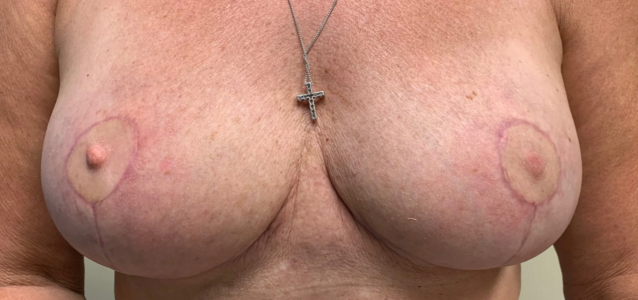 Scar Maturation &amp; Healing