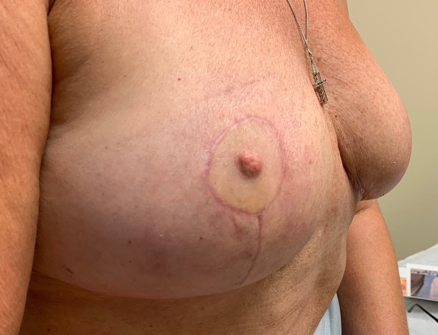 Scar Maturation &amp; Healing