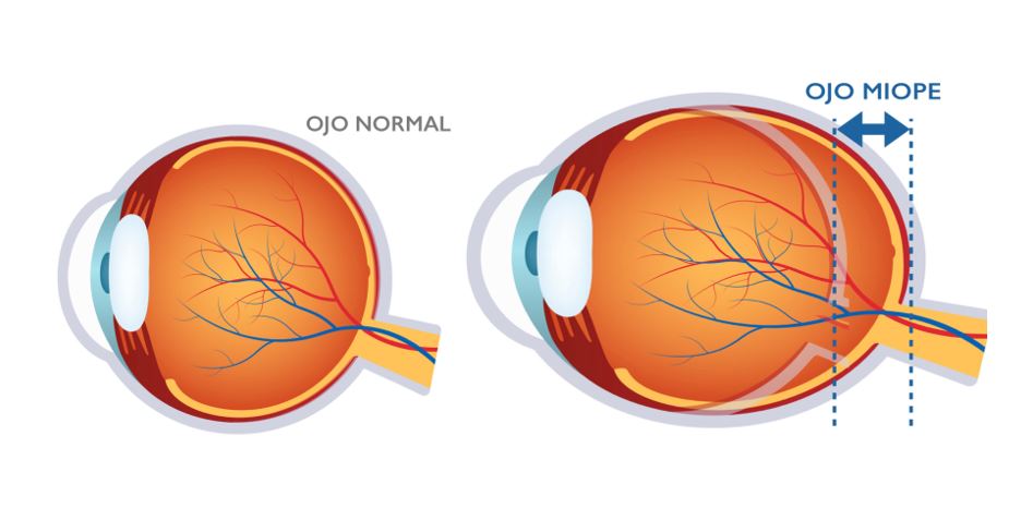 ojo-miope.jpg