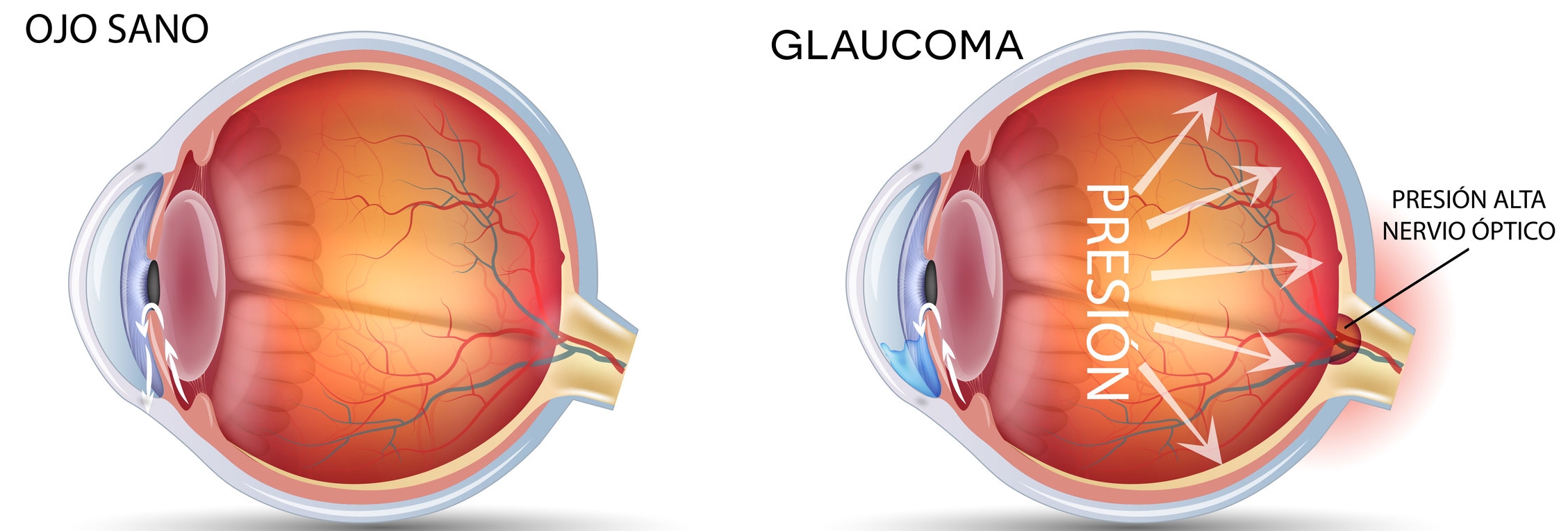 omiq_oftalmologia_medica_glaucoma-1.jpg