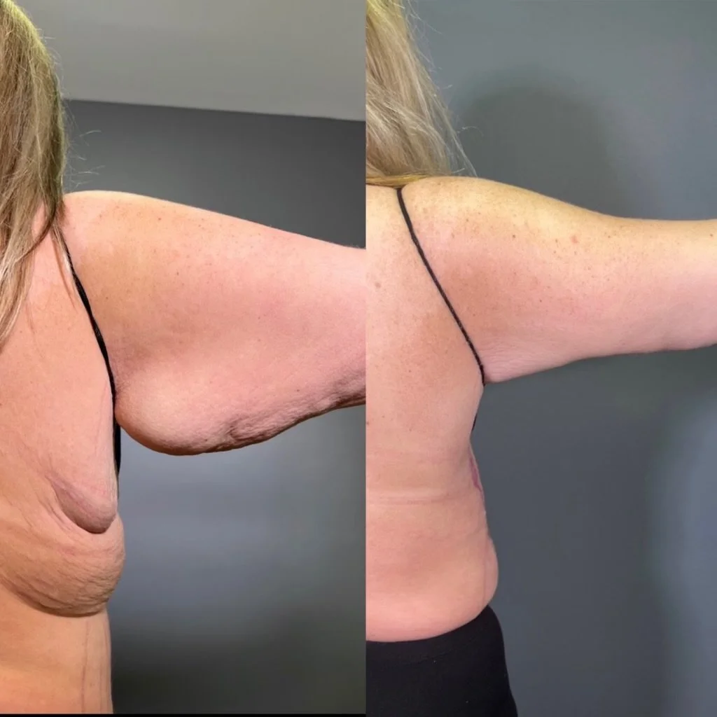 ARM LIPO + BRACHIOPLASTY (ARM LIFT)