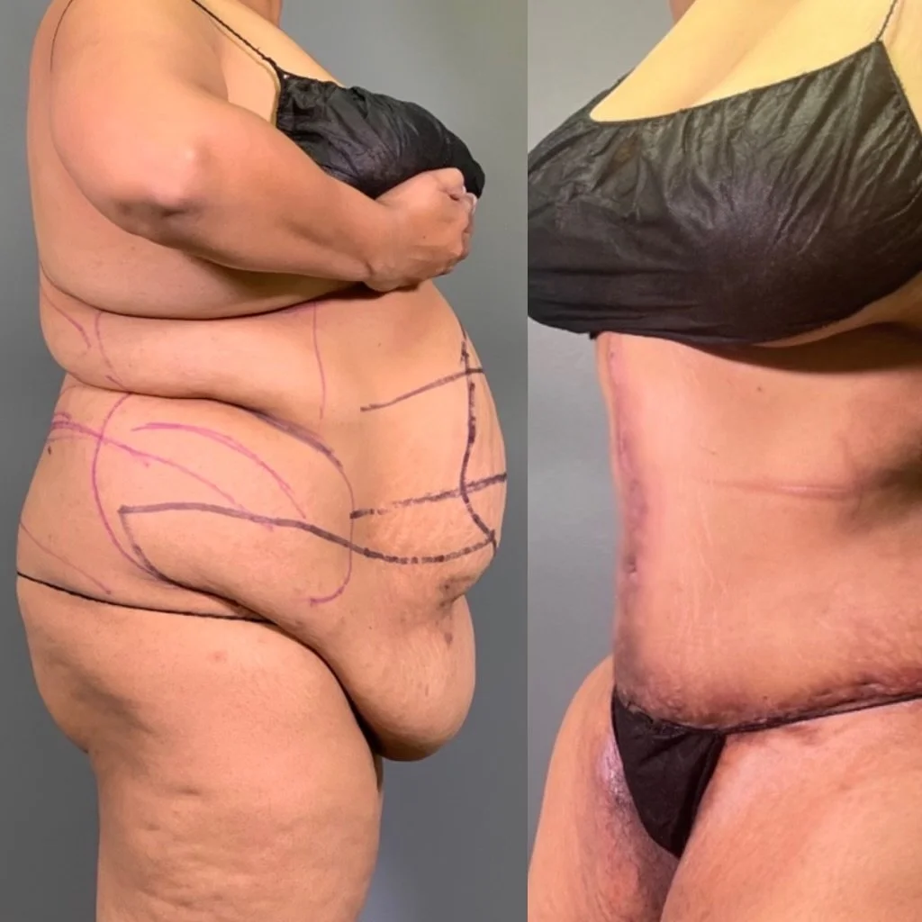 FLEUR DE LIS TUMMY TUCK + LIPO