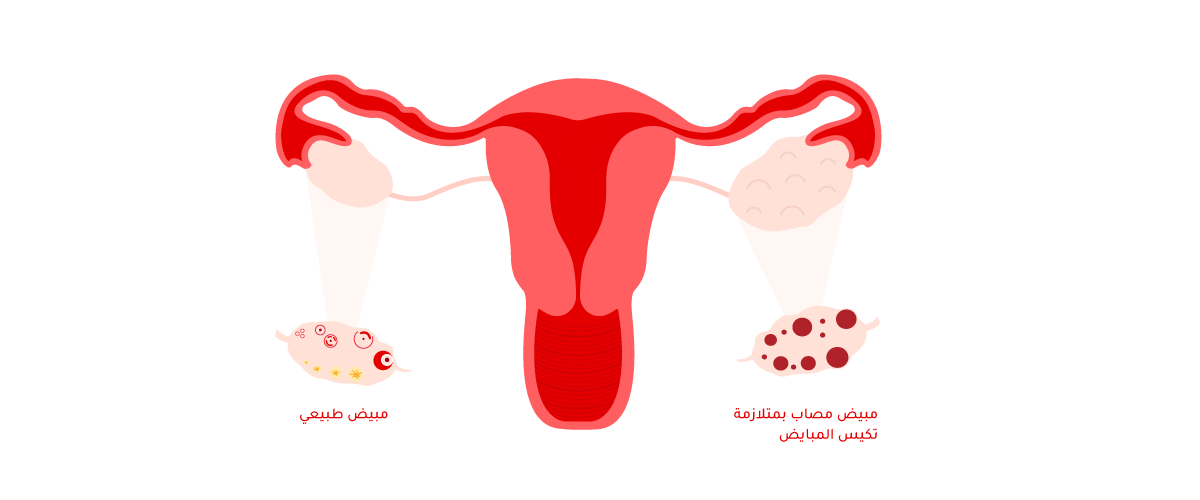 180818PCOS_mensabnormalities-web.png