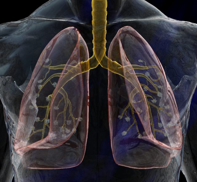 Lung2.jpg
